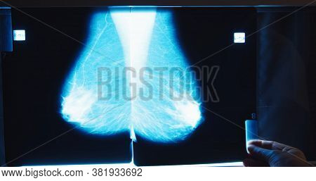 Doctor Examines Mammogram Snapshot Of Breast Of Female Patient On The Monitors. Breast Cancer Preven
