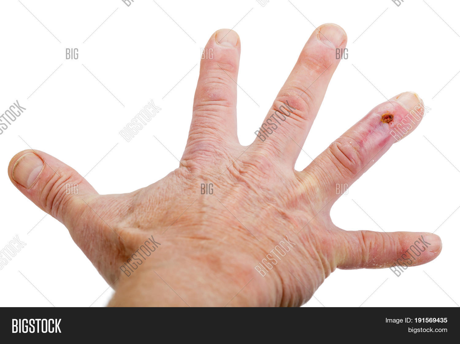 Postoperative Scar On Image & Photo (Free Trial) | Bigstock