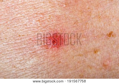 Close up photo of inflamed red spot on skin