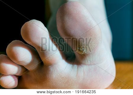 Plantar wart on big toe. Visible black dots warts. Shown the sole of the foot and toes.