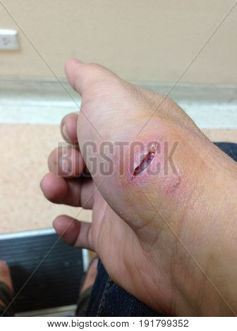 Big fresh wound on hand was bitten by mad dog. Crazy dog bite on skin puncture waiting for surgery to prevention inflame in hospital.