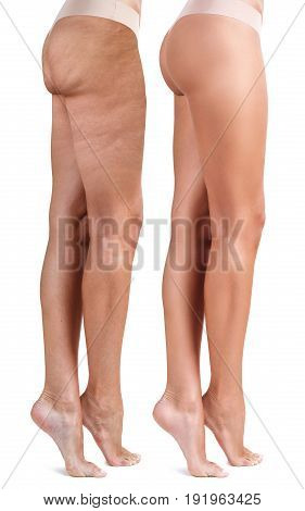 Buttocks of young woman before and after treatment. Cellulite problem concept.