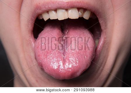 Male Shows Overgrowth Candidiasis On His Tongue