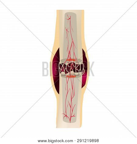 2 Stage Of Healing Bone Fracture. Formation Of Callus. The Bone Fracture. Infographics. Vector Illus