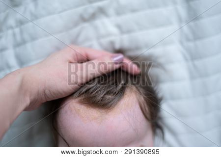 Seborrheic Dermatitis On Head Of The Baby. Newborn With Seborrhea, Close-up
