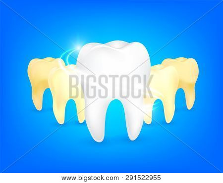 Set Of  Clean And Dirty Tooth. Step Of Yellow To White. Dental Care Concept, Illustration Isolated O