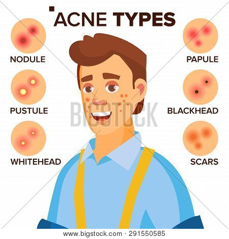 Acne Types . Man With Acne. Facial Skin Problems. Papule, Pustulem Scards. Isolated Flat Cartoon Cha