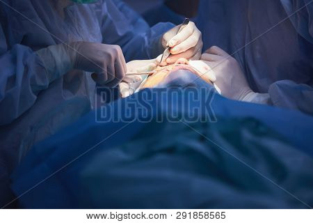 The Operation On The Eye. Cataract Surgery