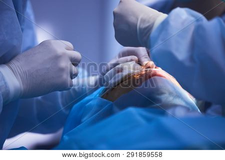 The Operation On The Eye. Cataract Surgery