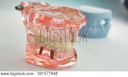 Dental Model On The Table Close-up. Acrylic Dental Model On The Table. Front View Of Plastic Dental 