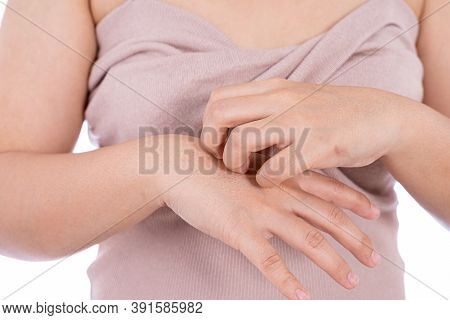 Female Scratching Her Hand Isolated White Background. Medical, Healthcare For Advertising Concept.