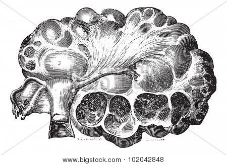 Multilocular cyst of the left ovary, vintage engraved illustration. Usual Medicine Dictionary - Paul Labarthe - 1885. 