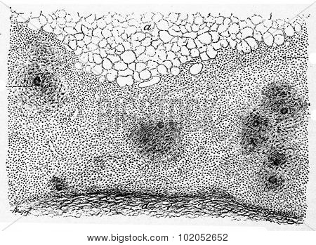 Acute tubercular pericarditis, vintage engraved illustration. 