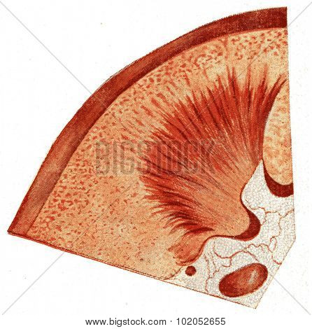 Kidney, acute parenchymatous nephritis, vintage engraved illustration. 