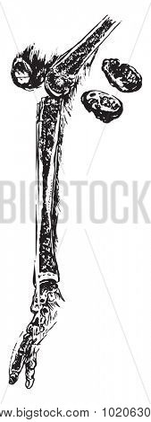Osteomyelitis involving the tibia, vintage engraved illustration. 