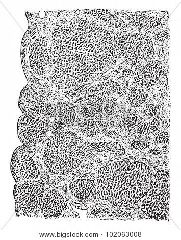 Atrophic cirrhosis of the liver, vintage engraved illustration. 