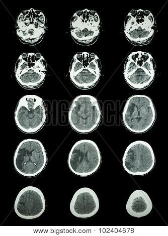 Ct Scan (computed Tomography) Of Brain Show Cerebral Infarction At Right Temporal-parietal Lobe
