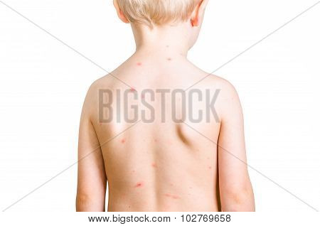 Child With Chickenpox