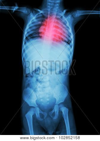 Rheumatic Heart Disease , Valvular Heart Disease  ( Film X-ray Body Of Child With Red Area At Heart