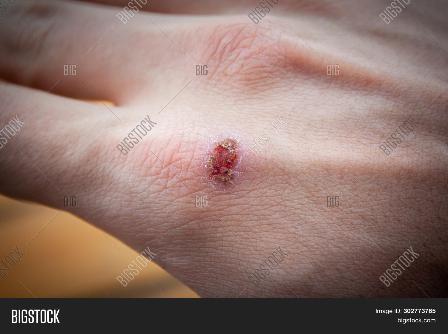 Healing Process Wound Image & Photo (Free Trial) Bigstock