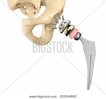 3d Illustration Of Hip Replacement Implant Installed In The Pelvis Bone