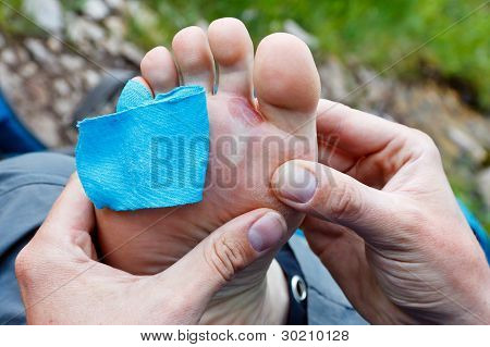 เท้าร้อน