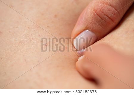 Close Up Picture Of Folliculitis On Female Skin - Hands Squeezing The Infected Follicle, Painful
