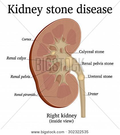 Illustration Of A Urological Disease Urolithiasis Also Known As Kidney Stone Disease. Shows The Loca