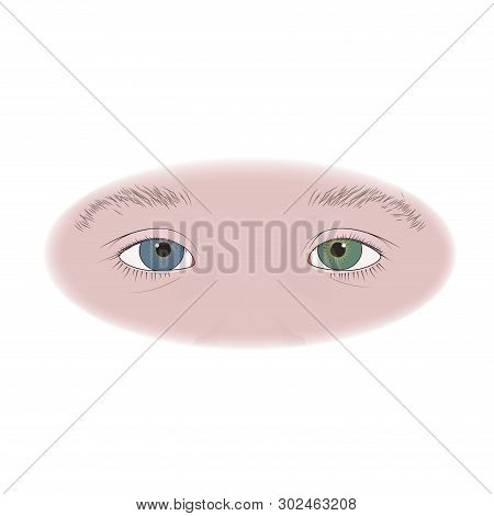 Different Colored Eyes In Infants, Kids, Child. Vector Flat Illustration.