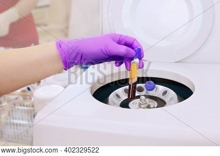 Medical Bottle With Blood Plasma In Hand For Prp, Extracted From The Centrifuge Machine For Plasma T