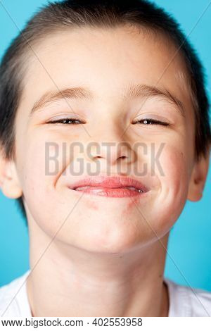 Portrait Of A Cheerful Smiling Boy With Mild Perioral Dermatitis On A Blue Background