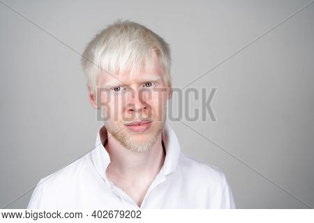 Albinism Albino Man In Studio Dressed T-shirt Isolated On A White Background. Abnormal Deviations. U