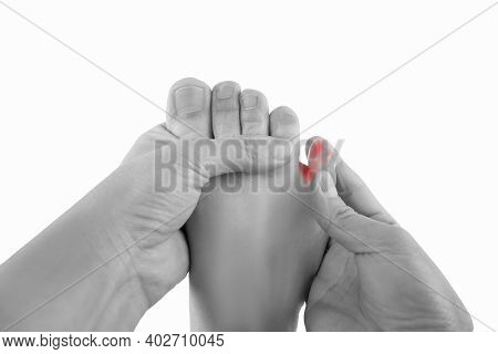 Ingrown Toenails On A Woman's Foot, Isolated On White Background, Pain In The Pinky Toe