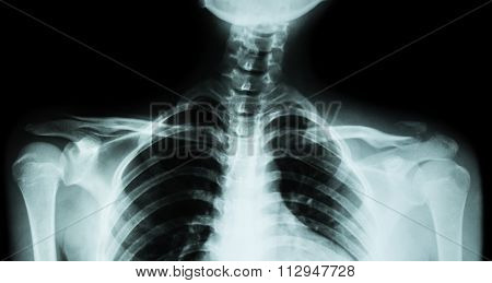 Film X-ray Both Clavicle Ap ( Front View ) : Show Fracture Distal Left Clavicle
