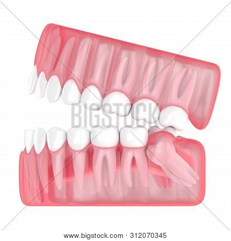 3d Render Of Jaw With Wisdom Mesial Impaction Over White Background. Concept Of Different Types Of W