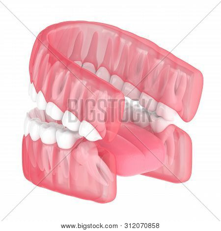 3d Render Of Jaw With Wisdom Mesial Impaction Over White Background. Concept Of Different Types Of W