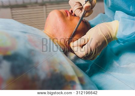 Aged Woman Doing Mesothreads And Thread Lifting, Cosmetology. Cosmetic Procedure To Eliminate Signs 