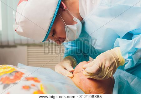 Aged Woman Doing Mesothreads And Thread Lifting, Cosmetology. Cosmetic Procedure To Eliminate Signs 