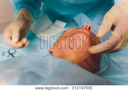 Aged Woman Doing Mesothreads And Thread Lifting, Cosmetology. Cosmetic Procedure To Eliminate Signs 