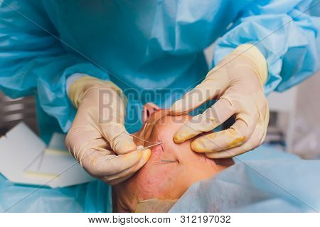 Aged Woman Doing Mesothreads And Thread Lifting, Cosmetology. Cosmetic Procedure To Eliminate Signs 