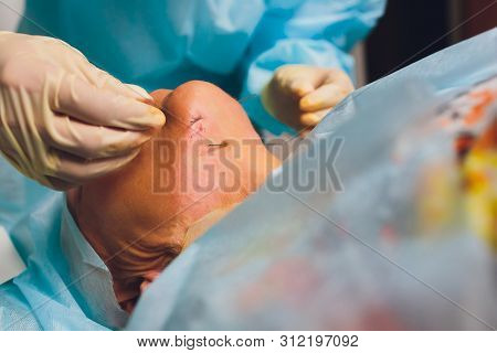 Aged Woman Doing Mesothreads And Thread Lifting, Cosmetology. Cosmetic Procedure To Eliminate Signs 