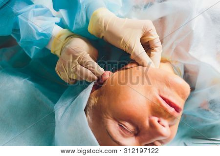 Aged Woman Doing Mesothreads And Thread Lifting, Cosmetology. Cosmetic Procedure To Eliminate Signs 