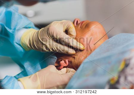 Aged Woman Doing Mesothreads And Thread Lifting, Cosmetology. Cosmetic Procedure To Eliminate Signs 