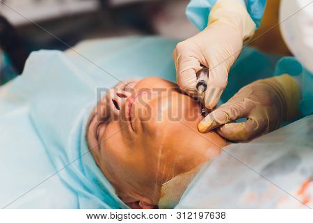 Aged Woman Doing Mesothreads And Thread Lifting, Cosmetology. Cosmetic Procedure To Eliminate Signs 