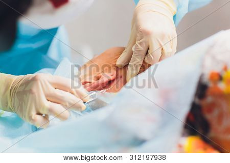 Aged Woman Doing Mesothreads And Thread Lifting, Cosmetology. Cosmetic Procedure To Eliminate Signs 