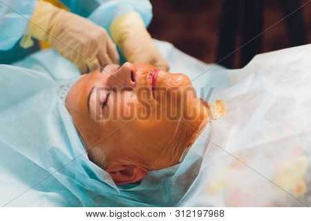 Aged Woman Doing Mesothreads And Thread Lifting, Cosmetology. Cosmetic Procedure To Eliminate Signs 