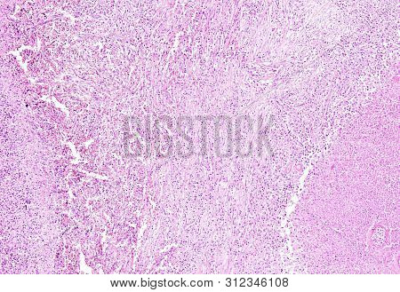 Histology Of Human Tissue, Show Spleen Infarction At A Scarring Stage As Seen Under The Microscope, 