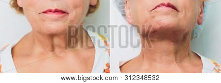 Aged Woman Doing Mesothreads And Thread Lifting, Cosmetology. Cosmetic Procedure To Eliminate Signs 