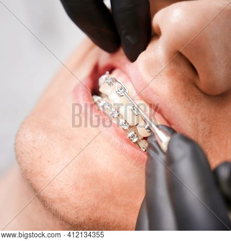 Dentist Placing Rubber Bands On Male Patient Braces.
