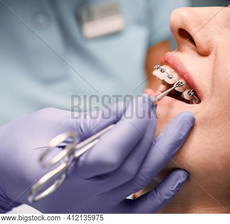 Orthodontist Hands Placing Braces On Woman Teeth.